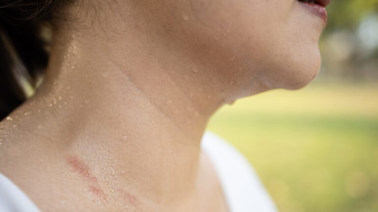 8 Smells That Mosquitoes Actually Love