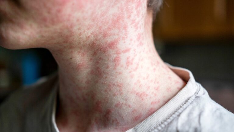 Measles containment criticism grows as health officials debate federal response
